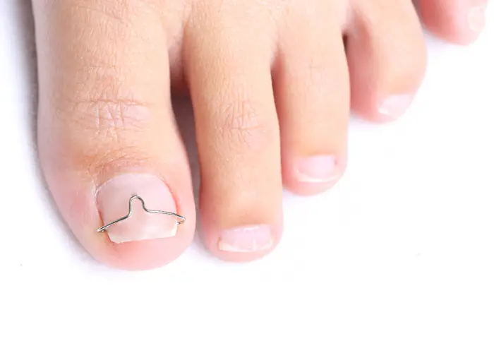 nagelbeugels nagelbeugels